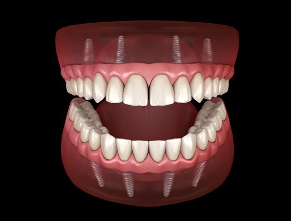 Implant Supported Denture